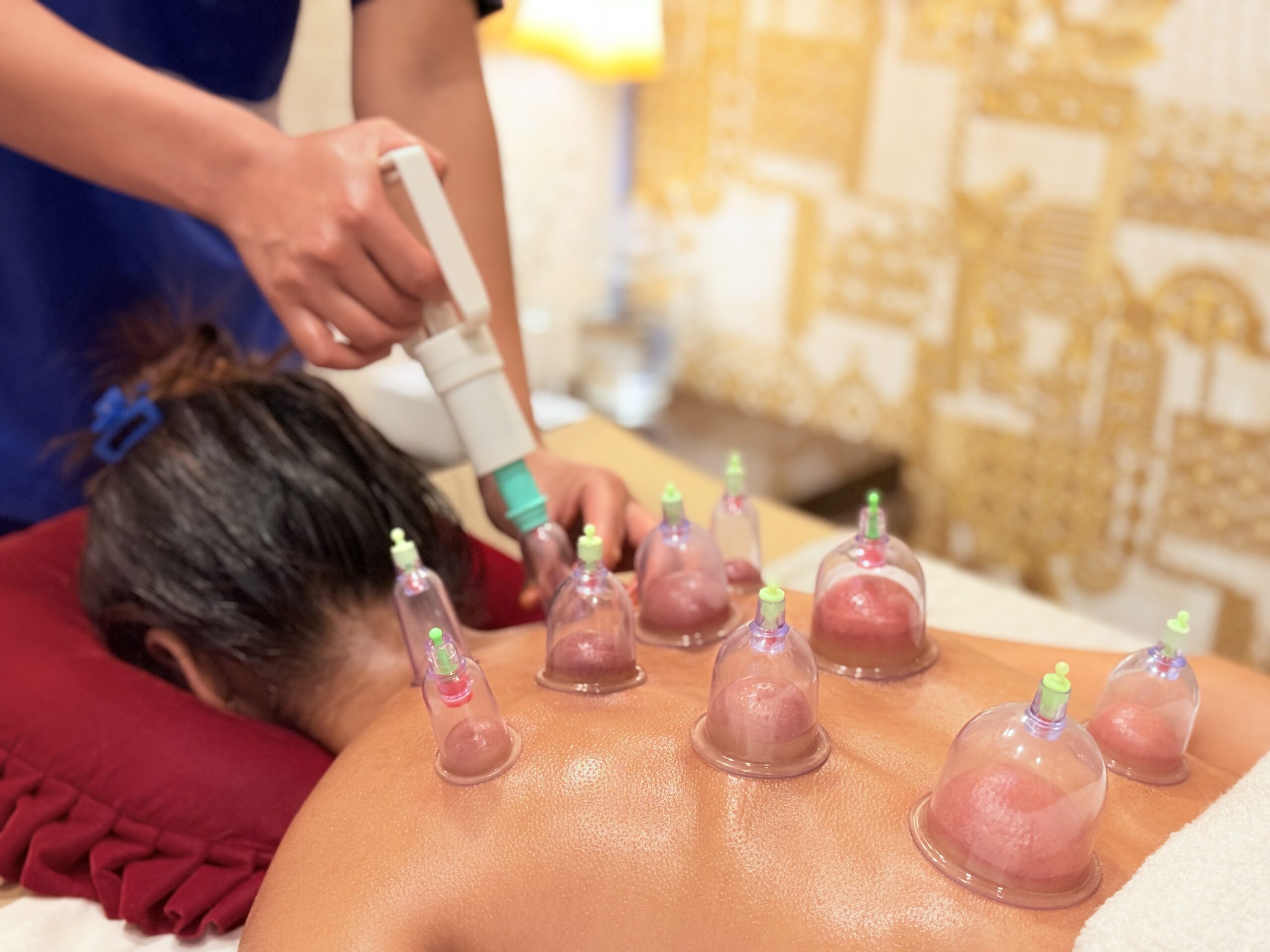 cupping massage therapy